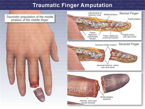 Traumatic Finger Amputation Trial Exhibits Inc