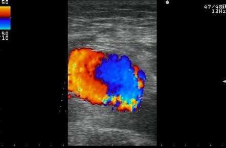 Post Traumatic Posterior Tibial Artery Pseudoaneurysm Image