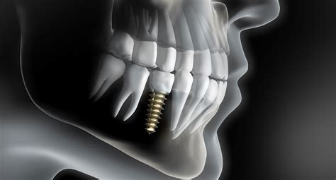 Implantologie M Nchen Methoden Und Kosten F R Zahnersatz