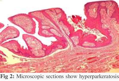 Figure 2 From Verruciform Xanthoma Of The Ventral Surface Of The Tongue