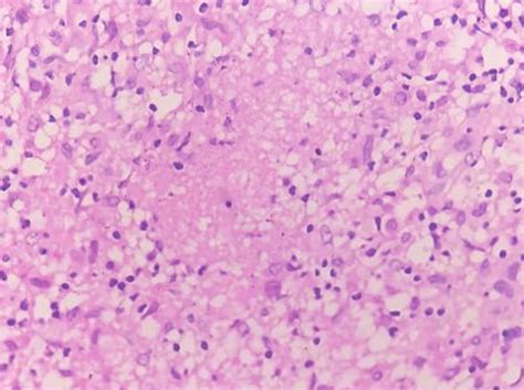 Epithelioid Granulomas With Central Caseous Necrosis ×400 H And E Download Scientific Diagram