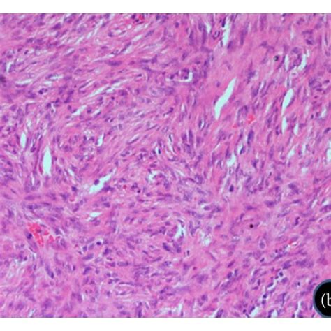 Microphotograph Shows Intersecting Marginated Groups Of Spindle Tumor