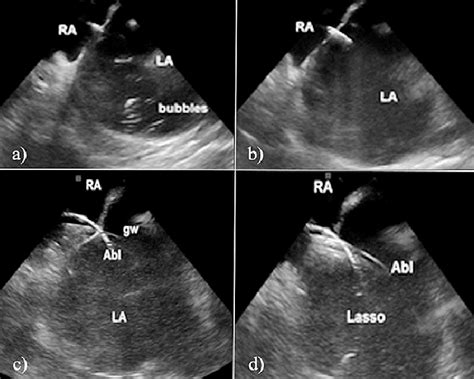 Successful Transseptal Puncture A Bubbles In The Left Atrium Confirm