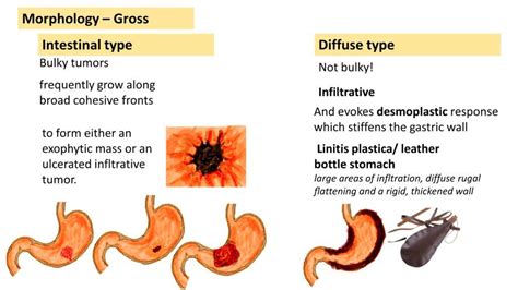 Carcinoma Stomach Intestinal Vs Diffuse Gastric Cancer Pathology