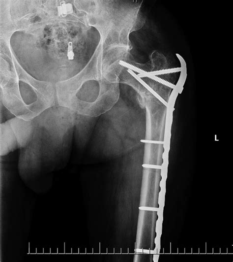 Proximal Femur Fracture