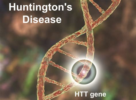 Huntington Disease Overview Rare Disease Advisor