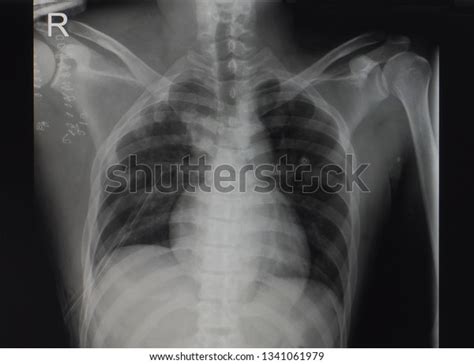 Anteroposterior Chest Radiograph Xray Showing Intercostal写真素材1341061979