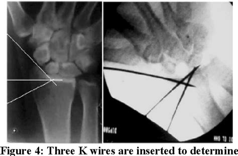 Figure 4 From Lateral Closing Wedge Osteotomy Of The Radial Styloid In