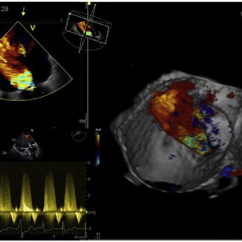 Three Dimensional Transesophageal Echocardiography From An Atrial