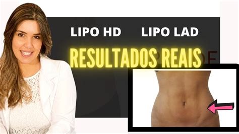 Lipo HD Lipo LAD Resultados Não faça antes de ver esse vídeo YouTube