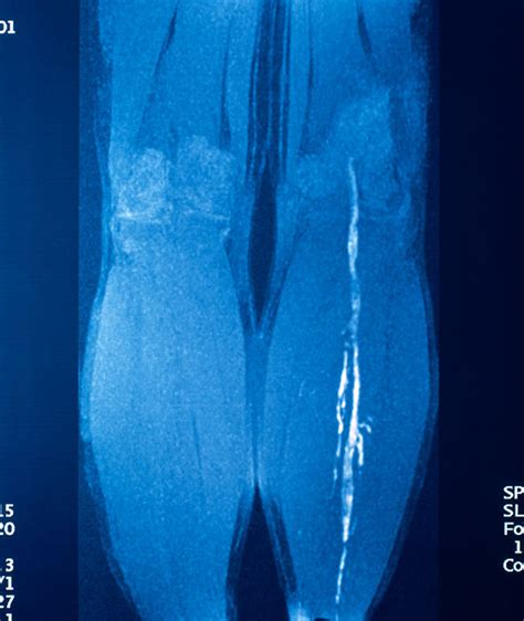 DVT symptoms: Four signs of deep vein thrombosis in your leg and calf ...