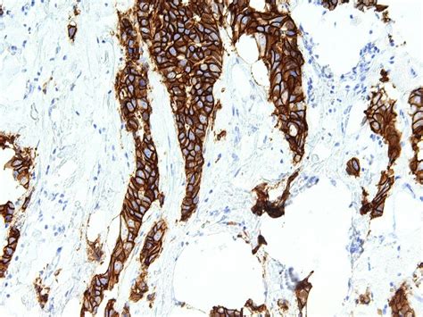 Non-inferiority of SC administration of Roche’s Perjeta and Herceptin