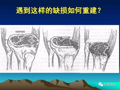 复杂性膝关节置换术的处理策略