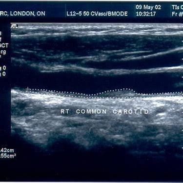 Results of male patients of carotid artery ultrasound images. | Download Scientific Diagram