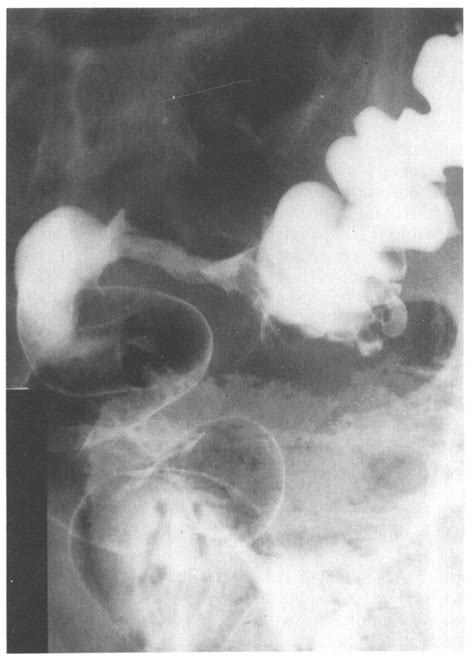 Short concentric radiation stenosis. The "apple core' lesion simulates ...