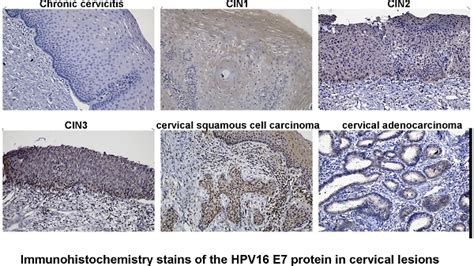 Immunohistochemical Detection Of Human Papillomavirus 16 E7 Oncoprotein