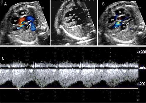 Fetal Echocardiographic Four Chamber View Showing The Aortic Left