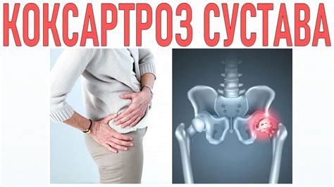 КОКСАРТРОЗ ТАЗОБЕДРЕННОГО СУСТАВА | Лечение тазобедренного сустава ...