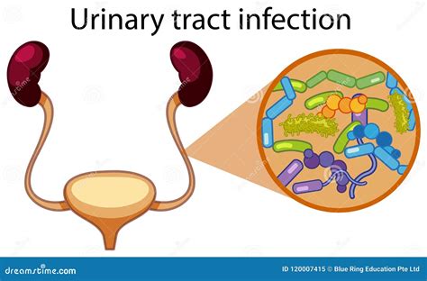 Human Urinary Tract Infection Stock Vector Illustration Of Scientific