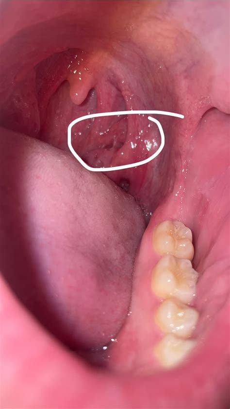 Generally healthy tonsils, but have 2 big crypts on left side, no pain ...