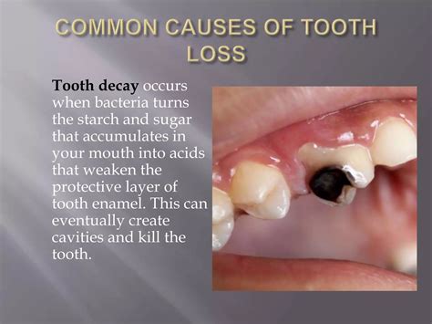 Importance Of Replacing Lost Teeth Ppt