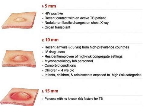 Pin On Tuberculin Skin Test Mantoux Test For Tb