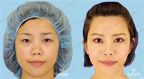 Asian Blepharoplasty Banda Wave Plastic Surgery