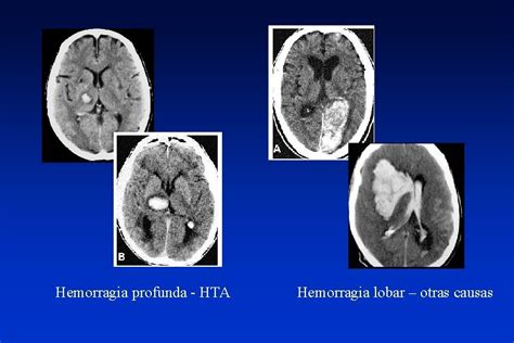 Enfermedades Vasculares Cerebrales Tema 3 Hemorragia Cerebral Definicin