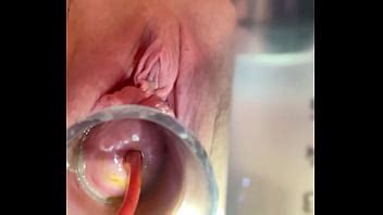 W Cc Inflation Of Catheter Balloon Inside Cervix XVIDEOS