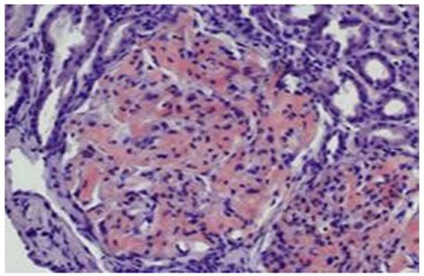 Amyloidoma And Plasmacytoma Presented As A Solitary Lung Nodule In A