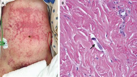 Strongyloides Stercoralis Hyperinfection New England Journal Of Medicine