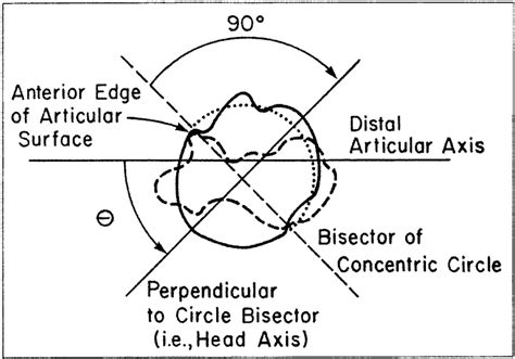 Diagram Demonstrating Measurement Of Humeral Head Retroversion