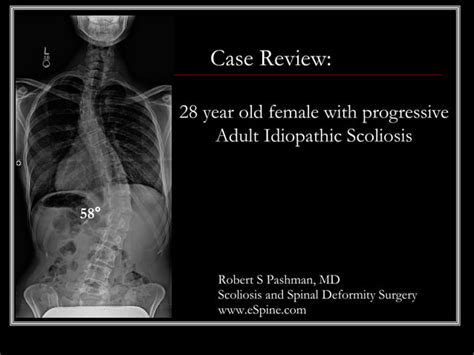 Case Presentation56 Adult Idiopathic Scoliosis Ppt