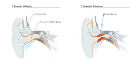 Gehörgangsentzündung Ursache Dauer und Therapie