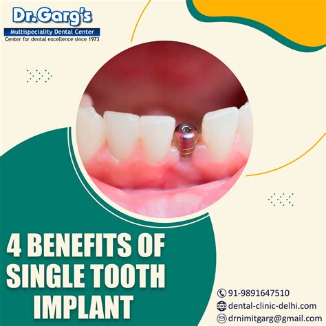 4 Benefits of Single Tooth Implant | by Nimit Garg | Medium