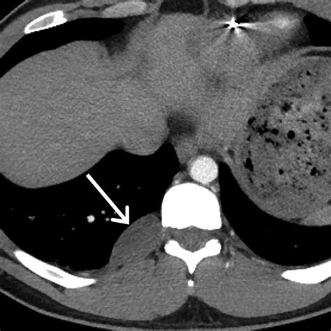 Imaging Of The Posteriorparavertebral Mediastinum Radiology Key