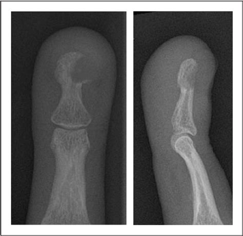 Figure From Peri Implant Radial And Ulnar Shaft Fractures After Volar