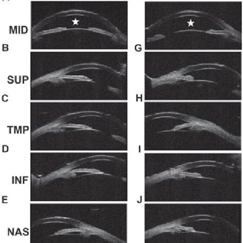 Ultrasound Biomicroscopy Ubm Of A E The Right Eye And F J The