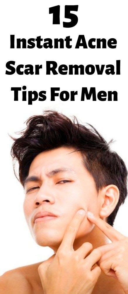 15 Instant Acne Scar Removal Tips For Men To Remember Natural Remedies