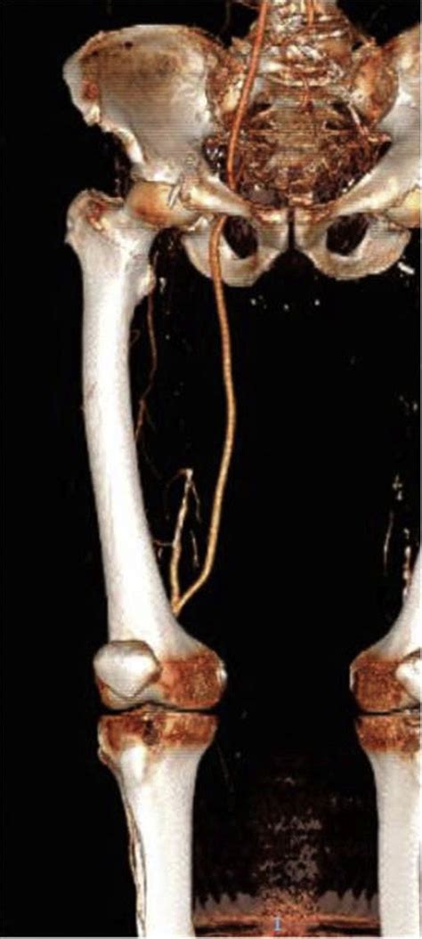 Iliac Above Knee Popliteal Bypass Through A Transobturator Approach Download Scientific Diagram