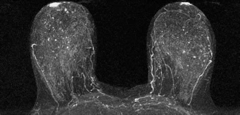 Are Qualitative Assessments Of Background Parenchymal Enhancement