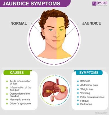 What is Yellow Skin? - Types, Symptoms, Treatment, Traditional Cures