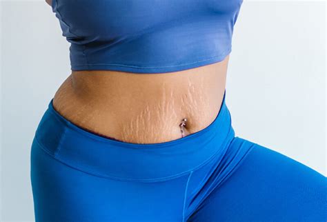 štala Loša sreća Uništenje bikini to cover stretch marks Suri Napušteno