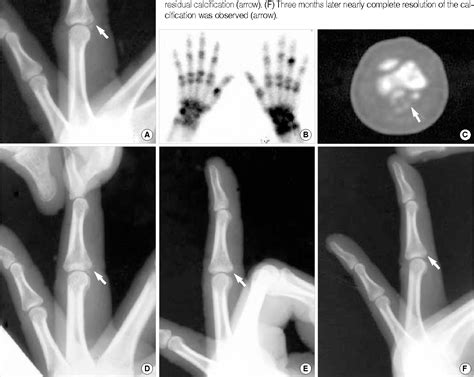 Pdf Acute Calcific Periarthritis Of Proximal Interphalangeal Joint In