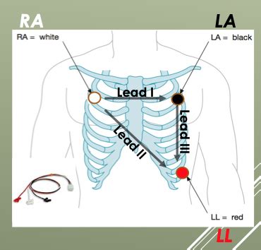 Ekg Interpretation Flashcards Quizlet