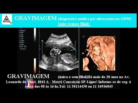 Gravimagem Ultrassom Morfol Gico D D Em Gravidez Semanas Mp