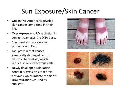 Skin Cancer From Sun Exposure