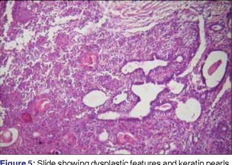 Figure 1 From Rare Carcinoma Ex Pleomorphic Adenoma Of The Buccal Minor