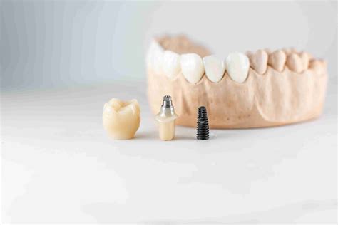 Implantes Dentales Valencia Amedent Clínica Dental en Valencia