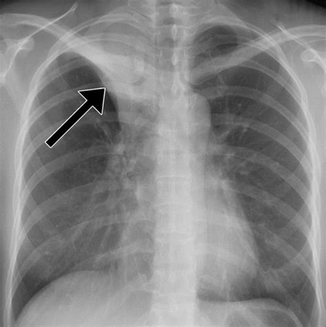 Pulmonary Tuberculosis Role Of Radiology In Diagnosis And Management